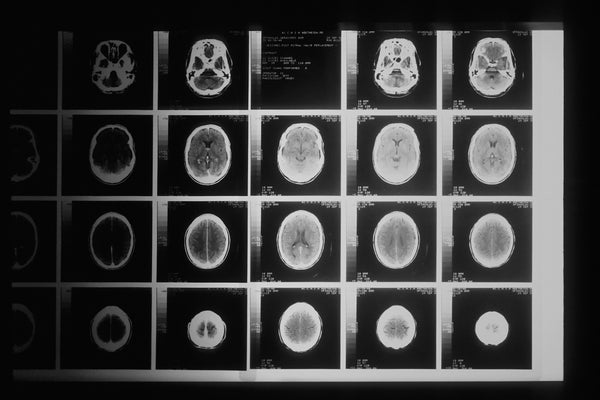 Brain Size Reduction after Mild Covid